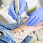 detatouage laser tatouage tatoo detatoo caen mondeville